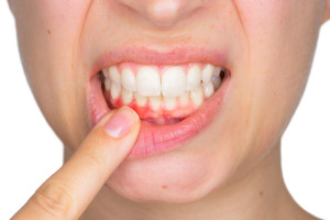 Qu’est ce qu’une parodontite ?