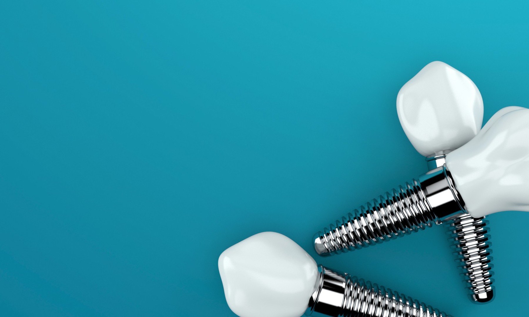 Qu'est-ce qu'un implant dentaire ? Indications et contre-indications